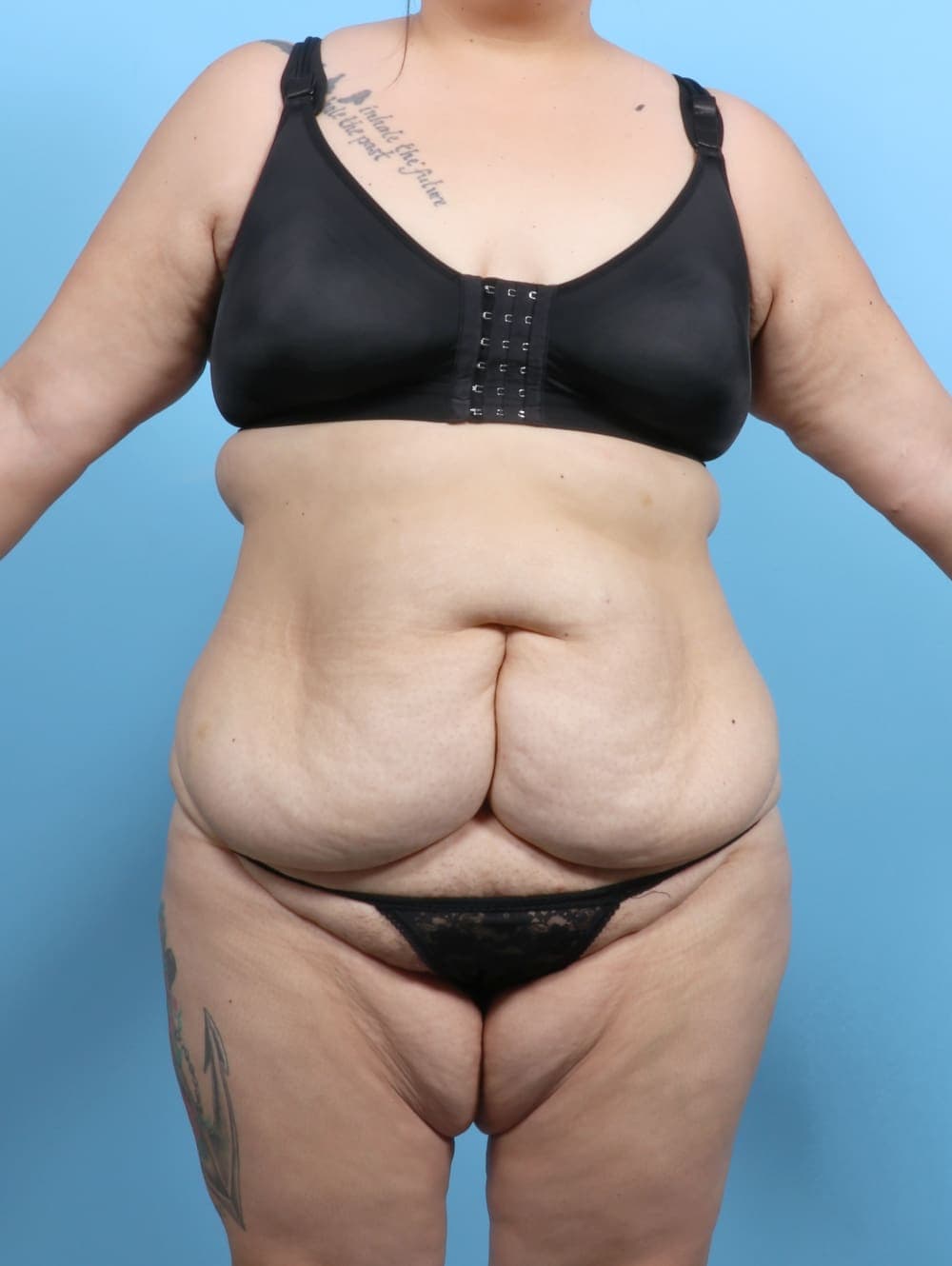 Tummy Tuck case #6383 before, image 1