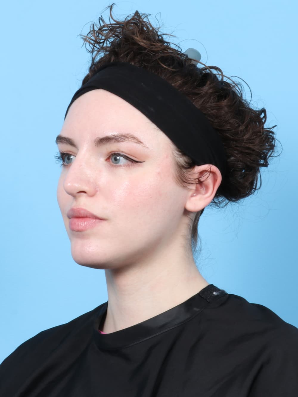 Rhinoplasty case #7839 after, image 3
