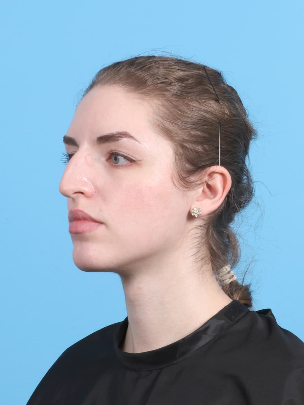 Rhinoplasty case #7839 before, image 3