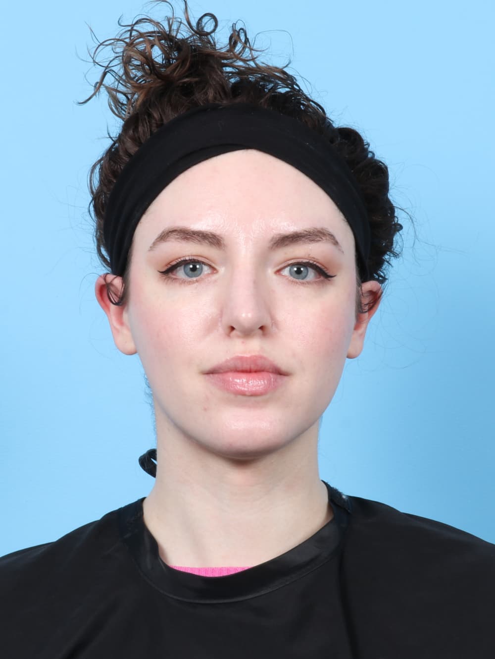 Rhinoplasty case #7839 after, image 2