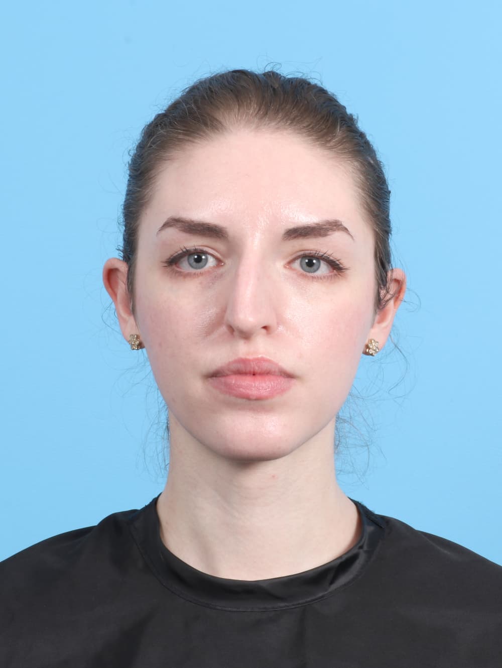 Rhinoplasty case #7839 before, image 2