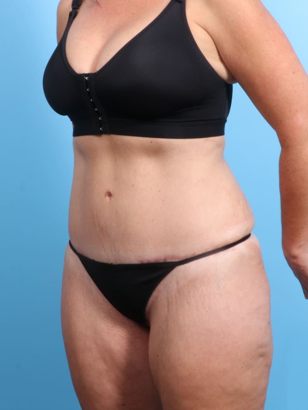 Tummy Tuck case #2032 after, image 2
