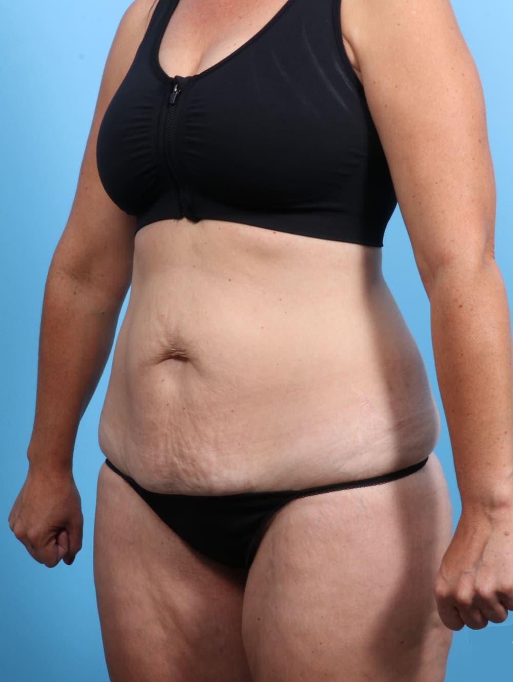 Tummy Tuck case #2032 before, image 2