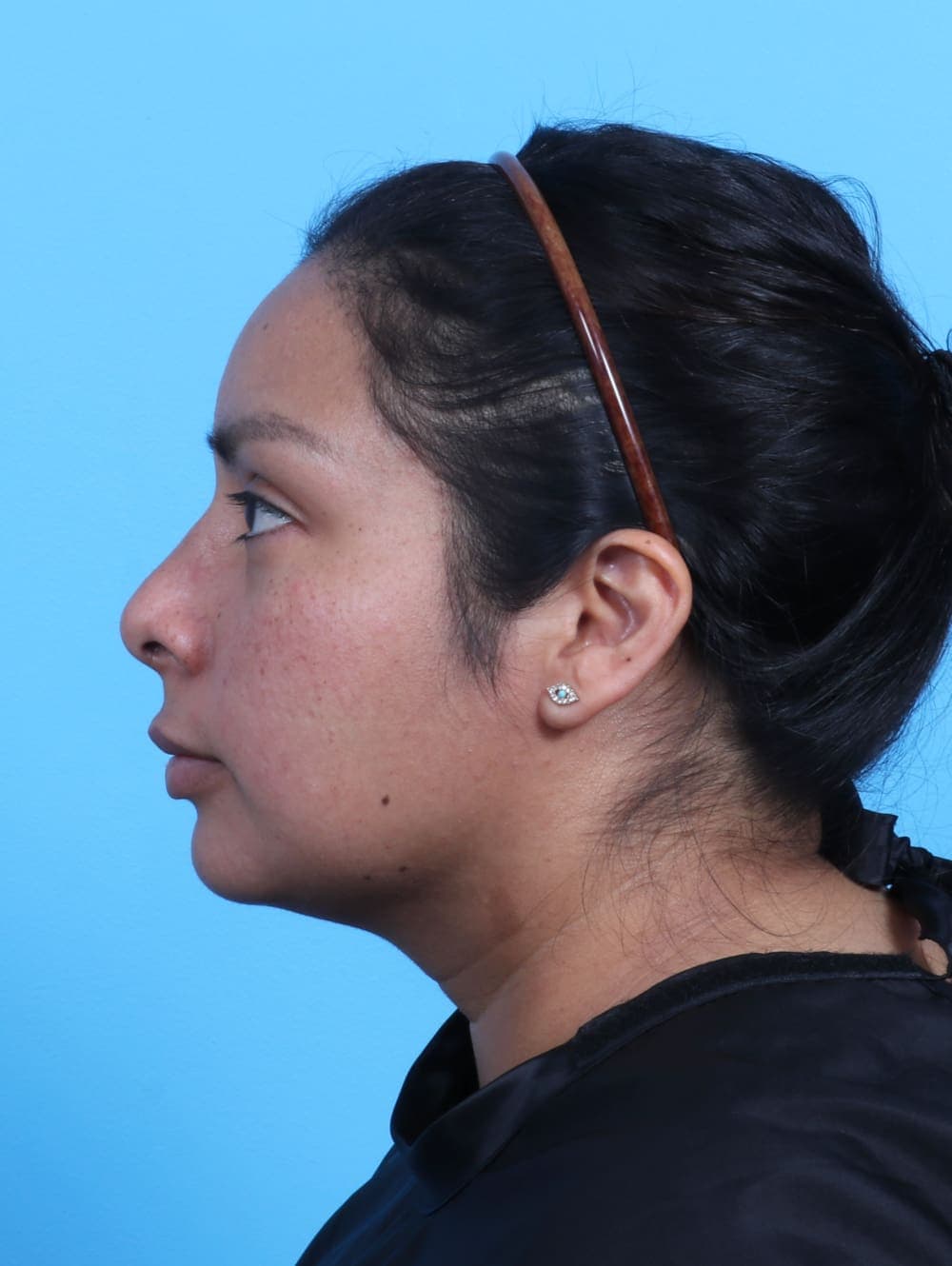 Rhinoplasty case #3319 after