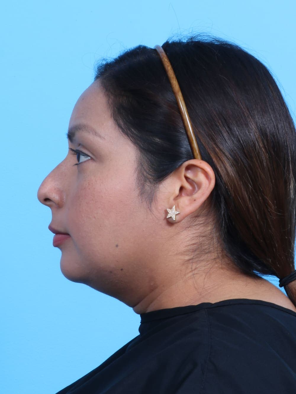 Rhinoplasty case #3319 before