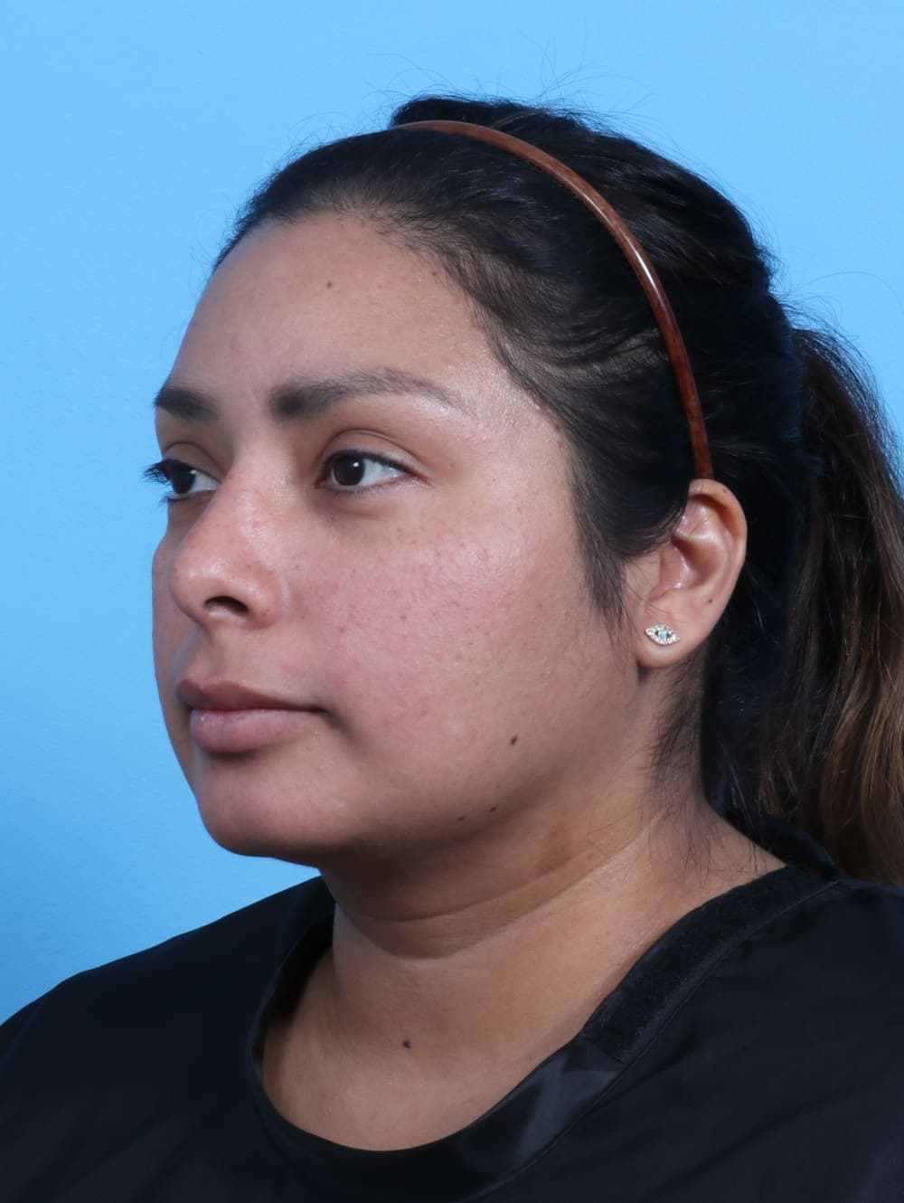 Rhinoplasty case #3319 after, image 3