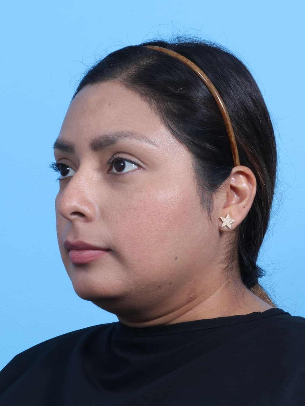 Rhinoplasty case #3319 before, image 3