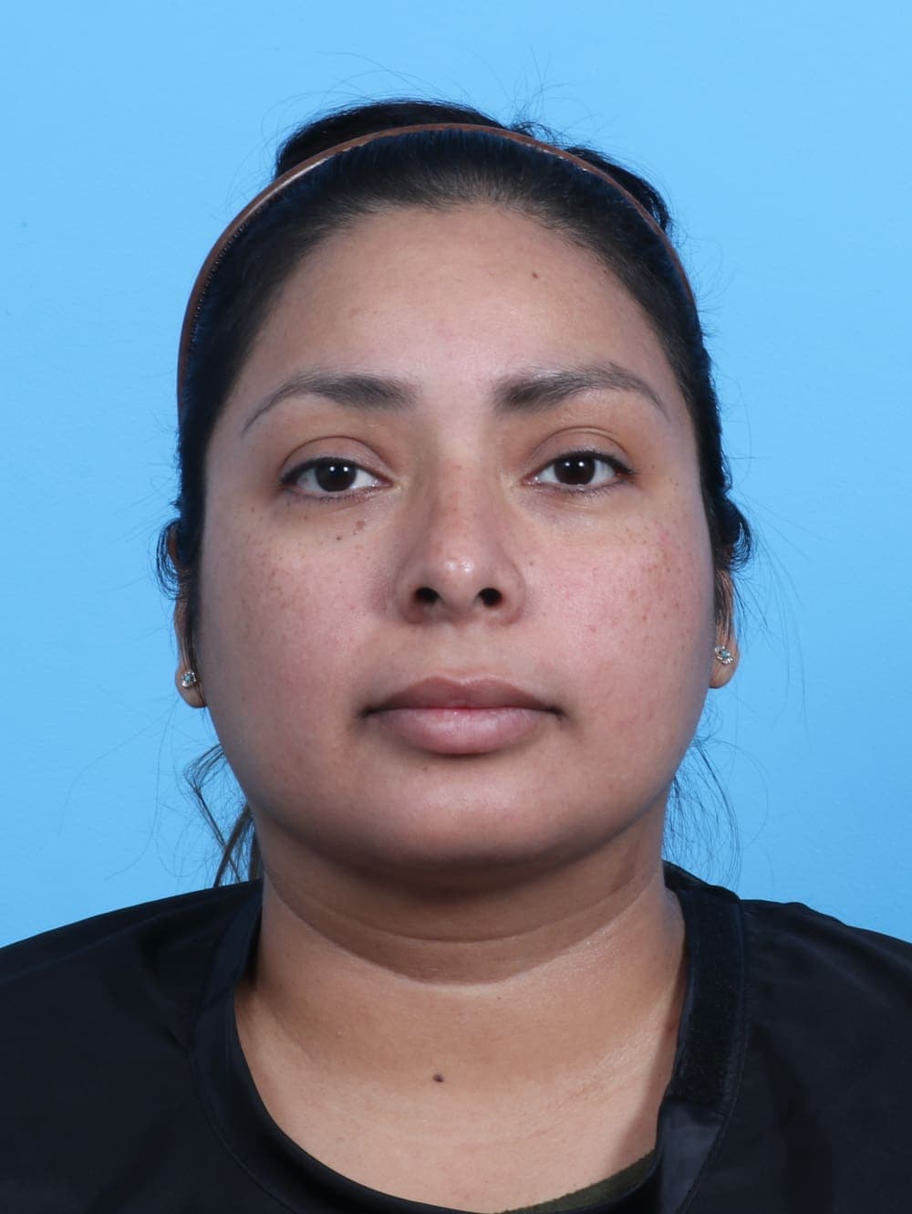 Rhinoplasty case #3319 after, image 2