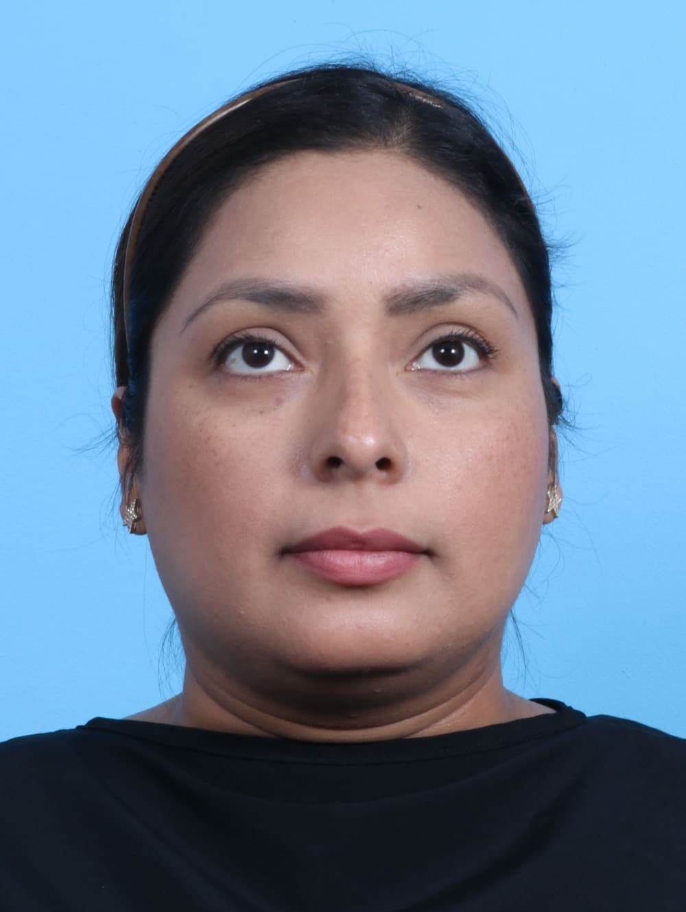 Rhinoplasty case #3319 before, image 2