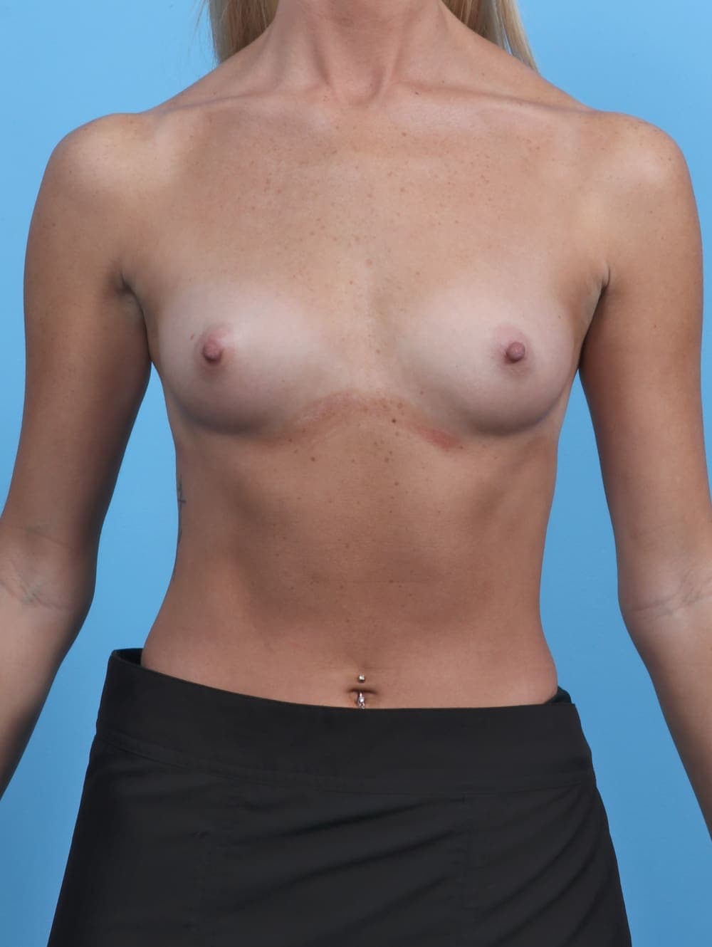 Breast Augmentation case #5626 before, image 1