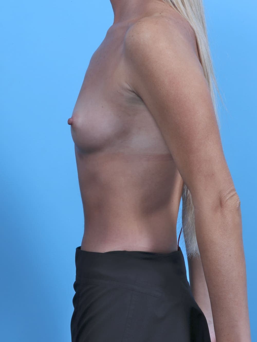 Breast Augmentation case #5626 before, image 3