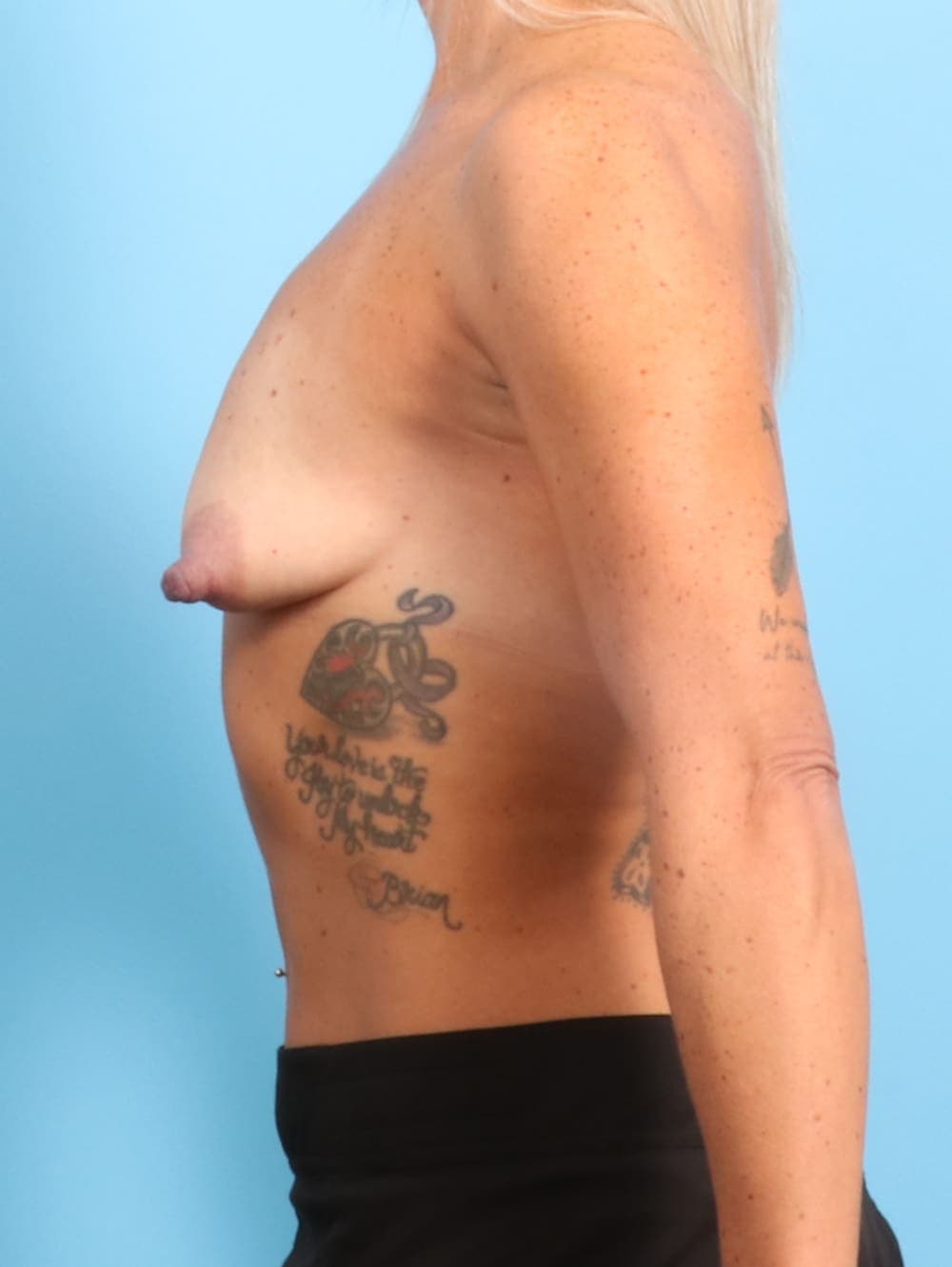 Breast Lift with Implants case #2609 before, image 3