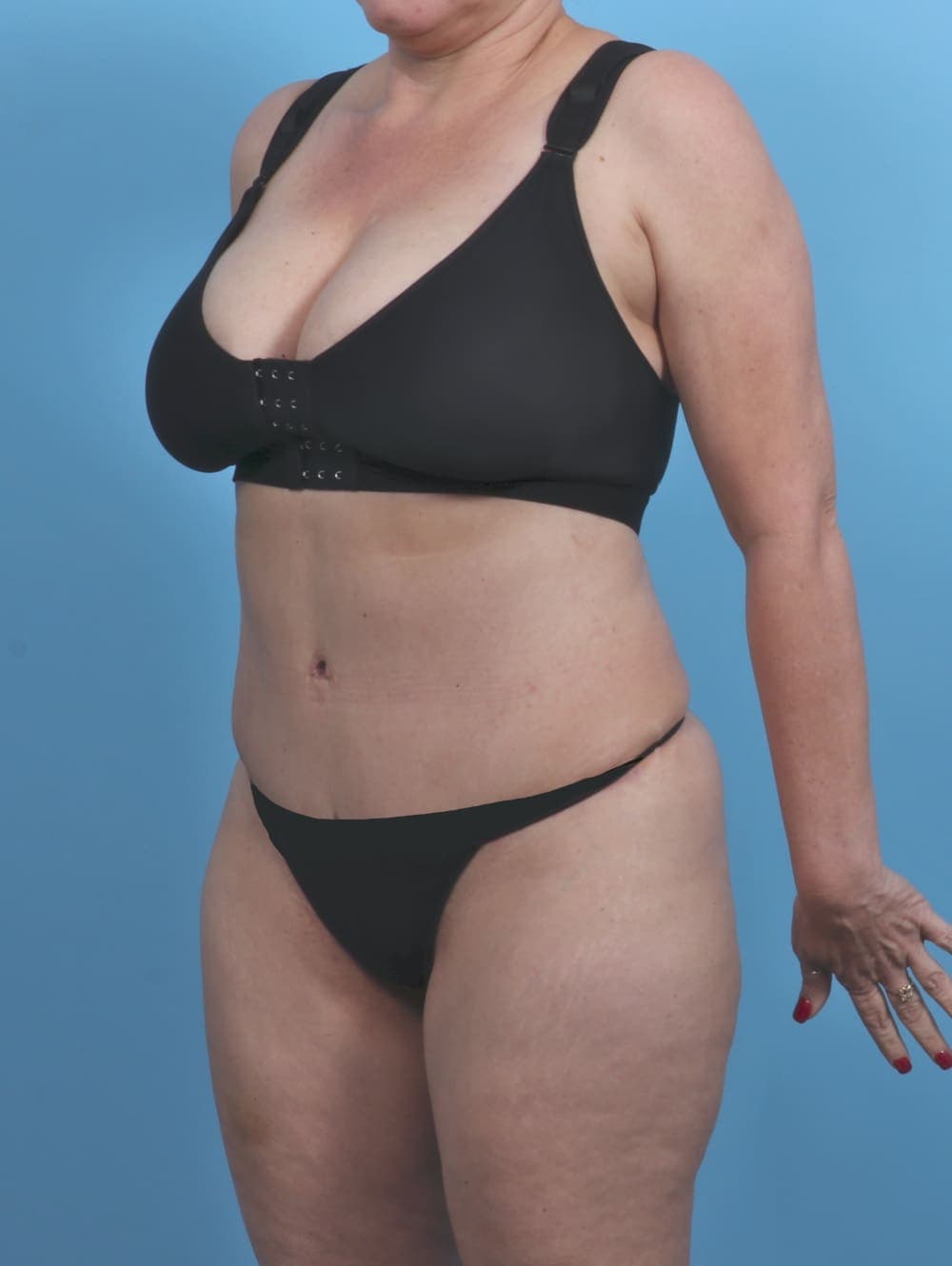 Liposuction case #4874 after, image 2