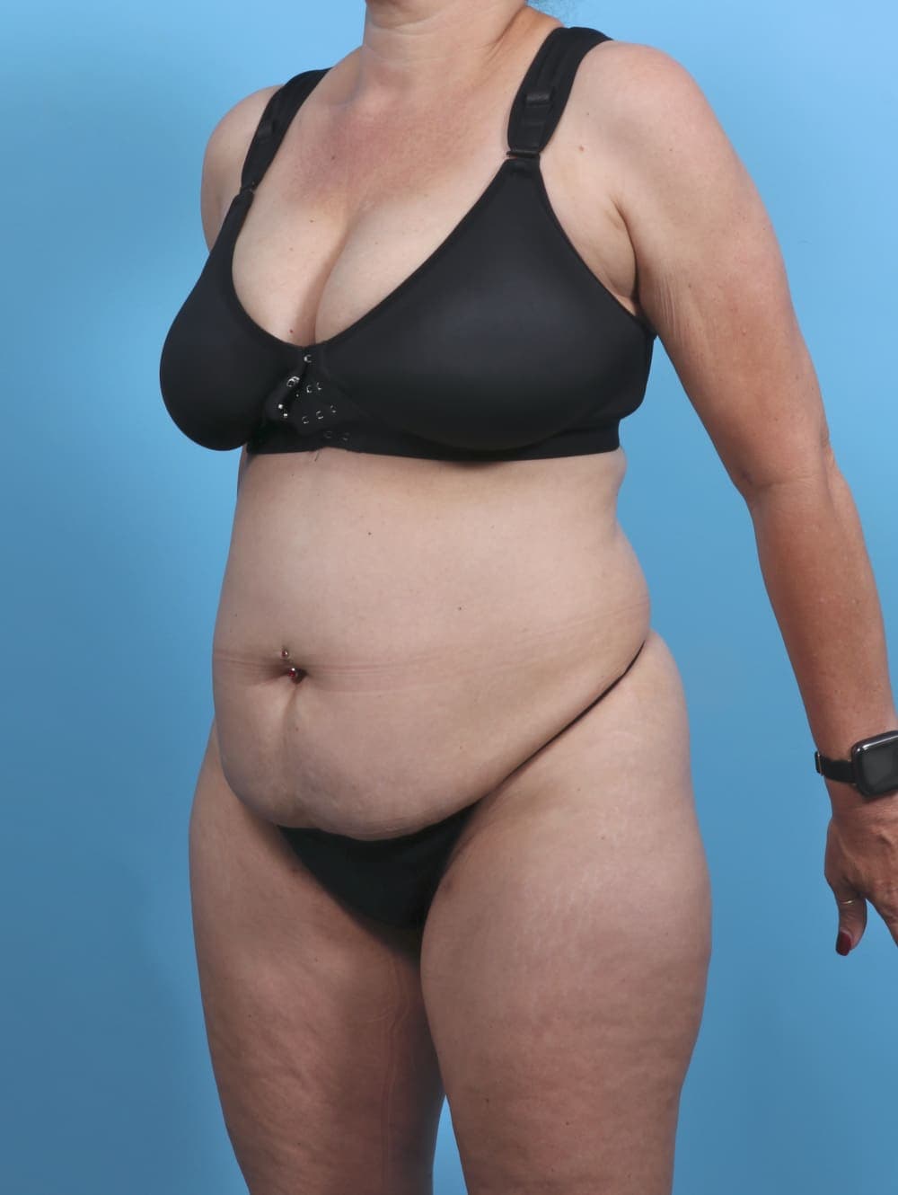 Liposuction case #4874 before, image 2