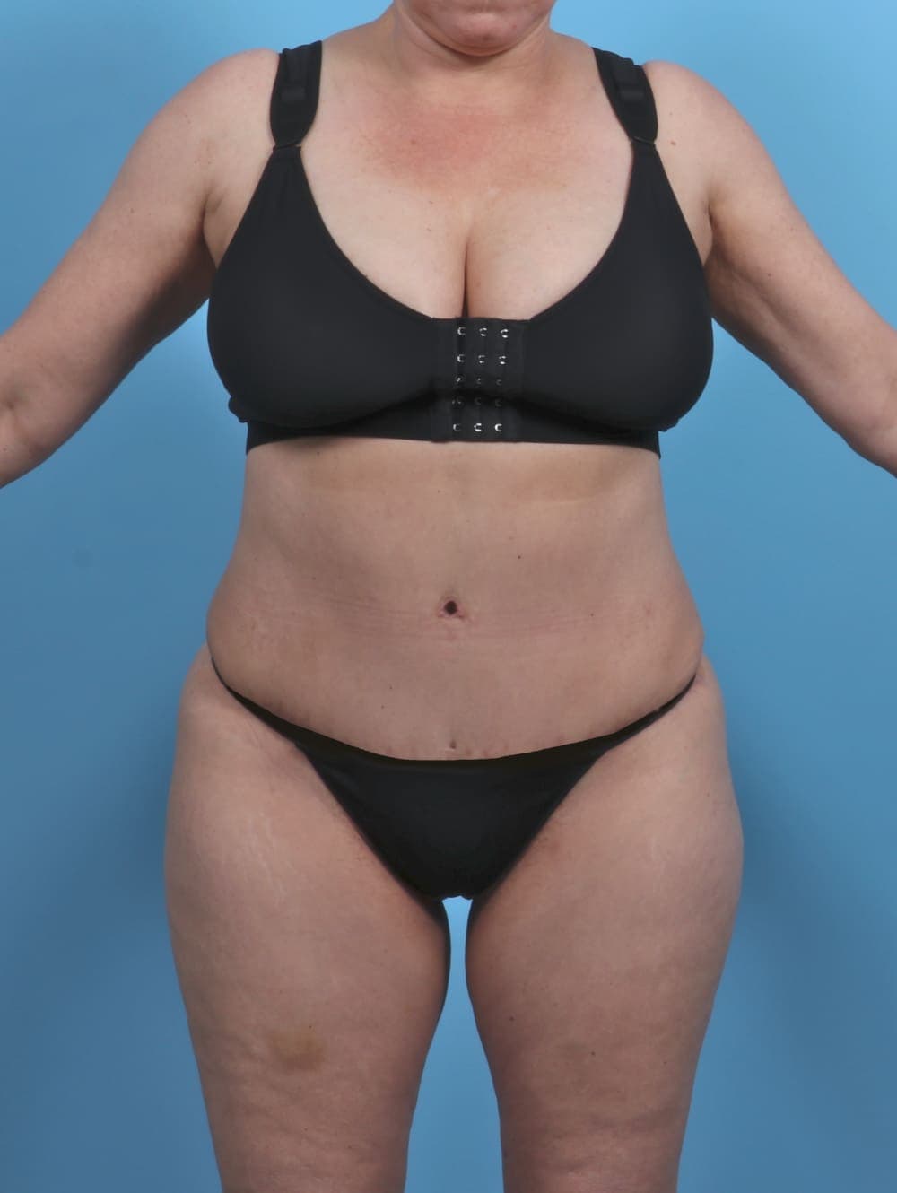 Liposuction case #4874 after, image 1