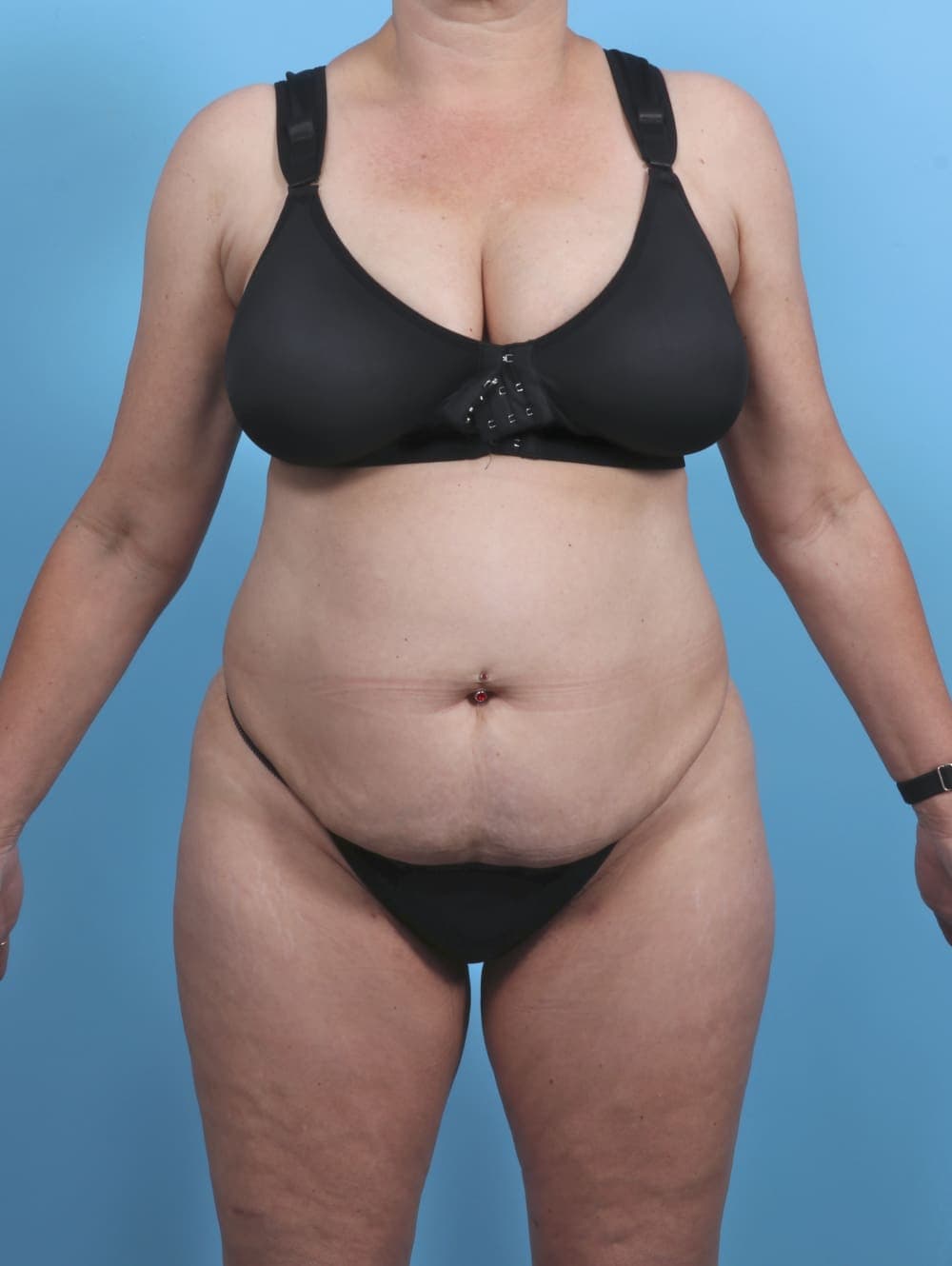 Liposuction case #4874 before, image 1