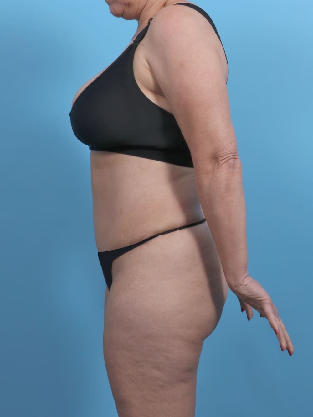 Liposuction case #4874 after, image 3