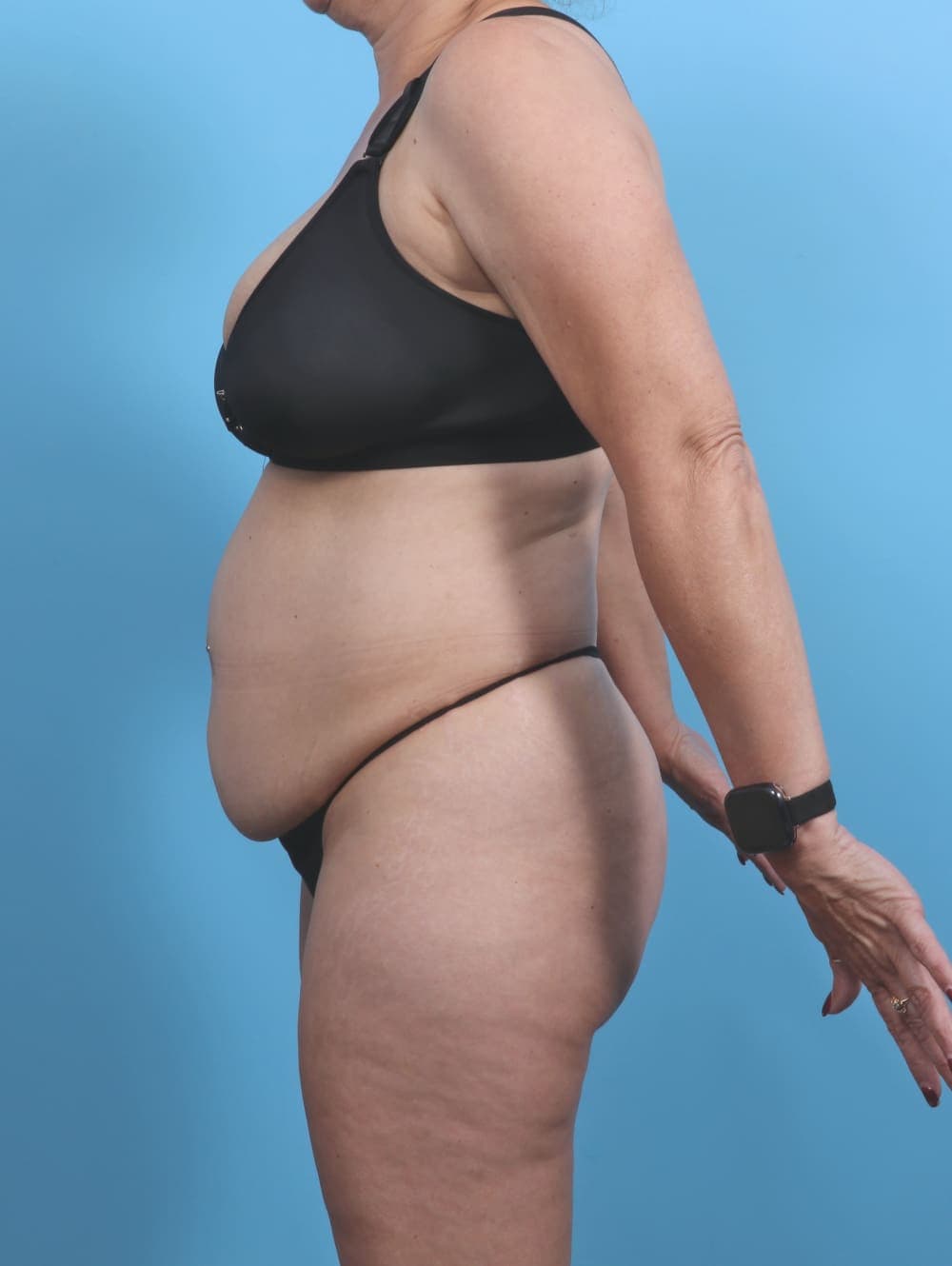 Liposuction case #4874 before, image 3