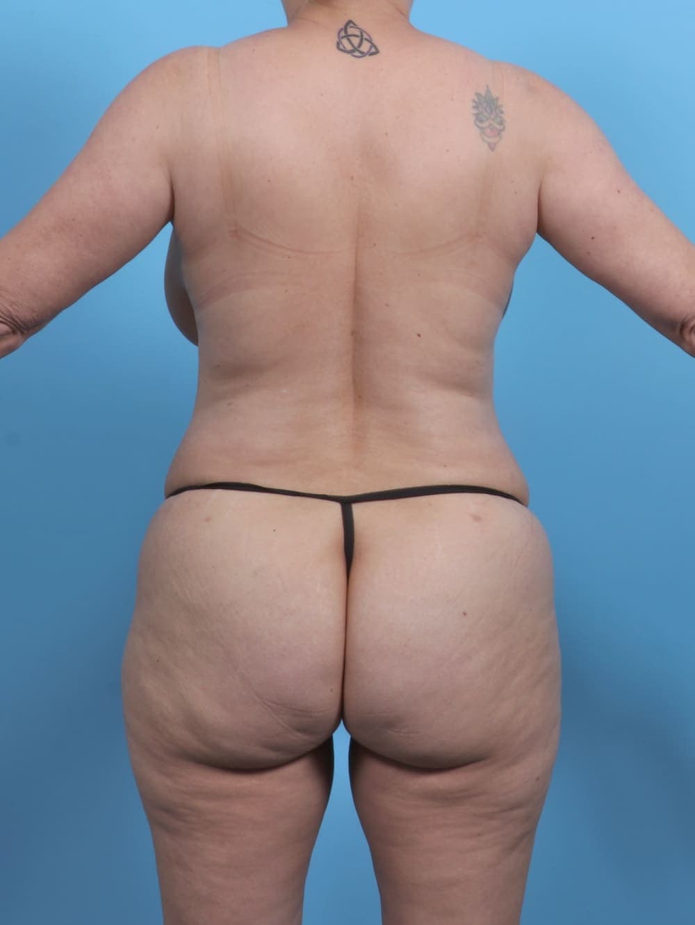 Liposuction case #4874 after, image 4