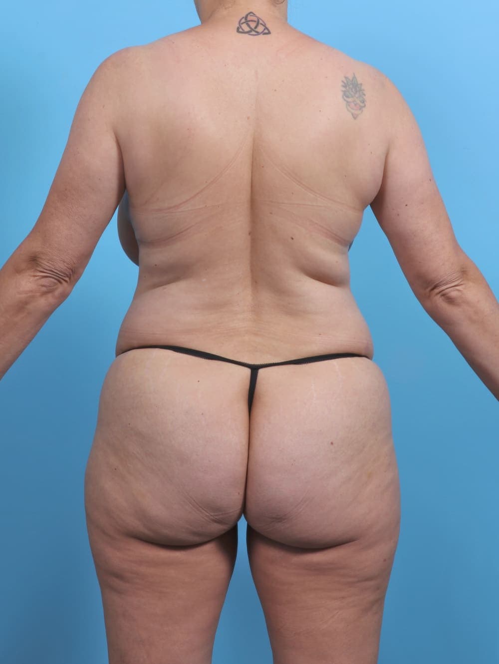 Liposuction case #4874 before, image 4