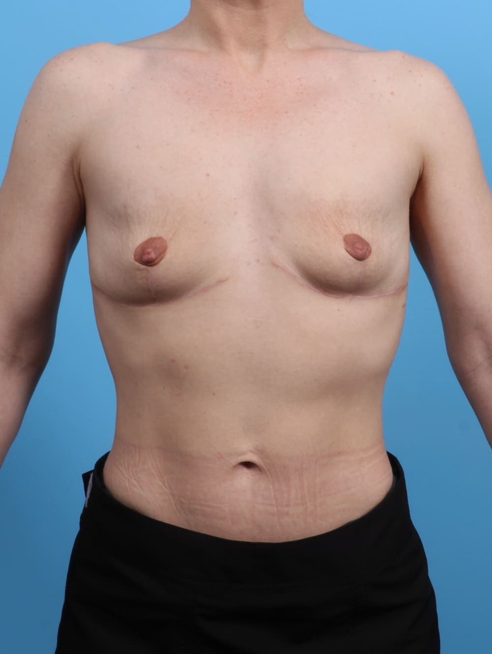 Breast Implant Removal with Lift case #3526 after, image 1