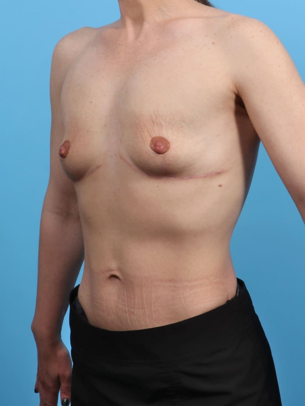 Breast Implant Removal with Lift case #3526 after, image 2
