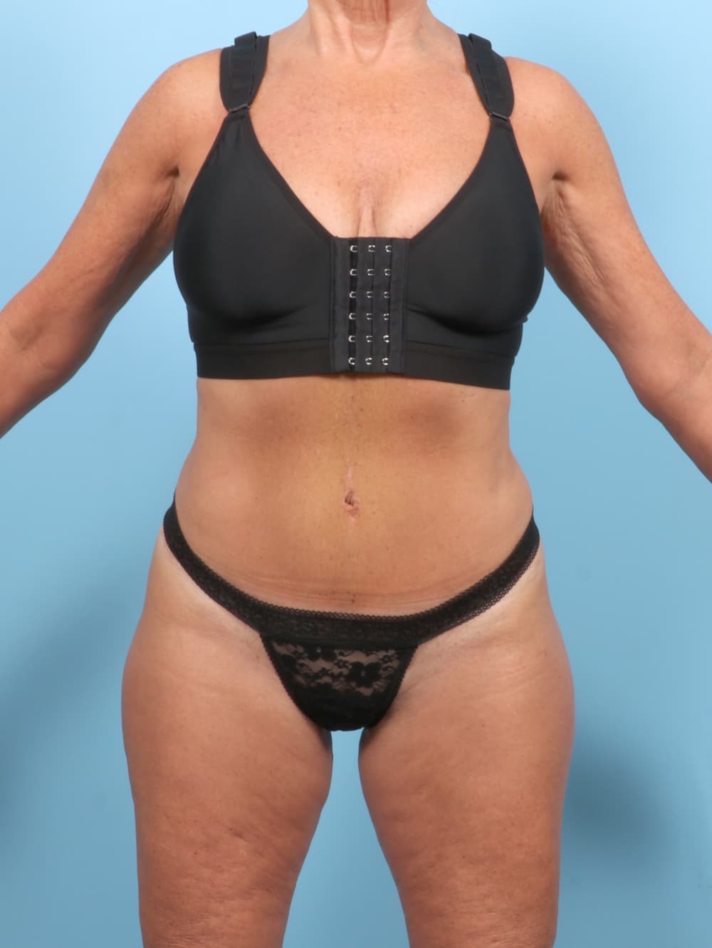 Tummy Tuck case #7355 after, image 1