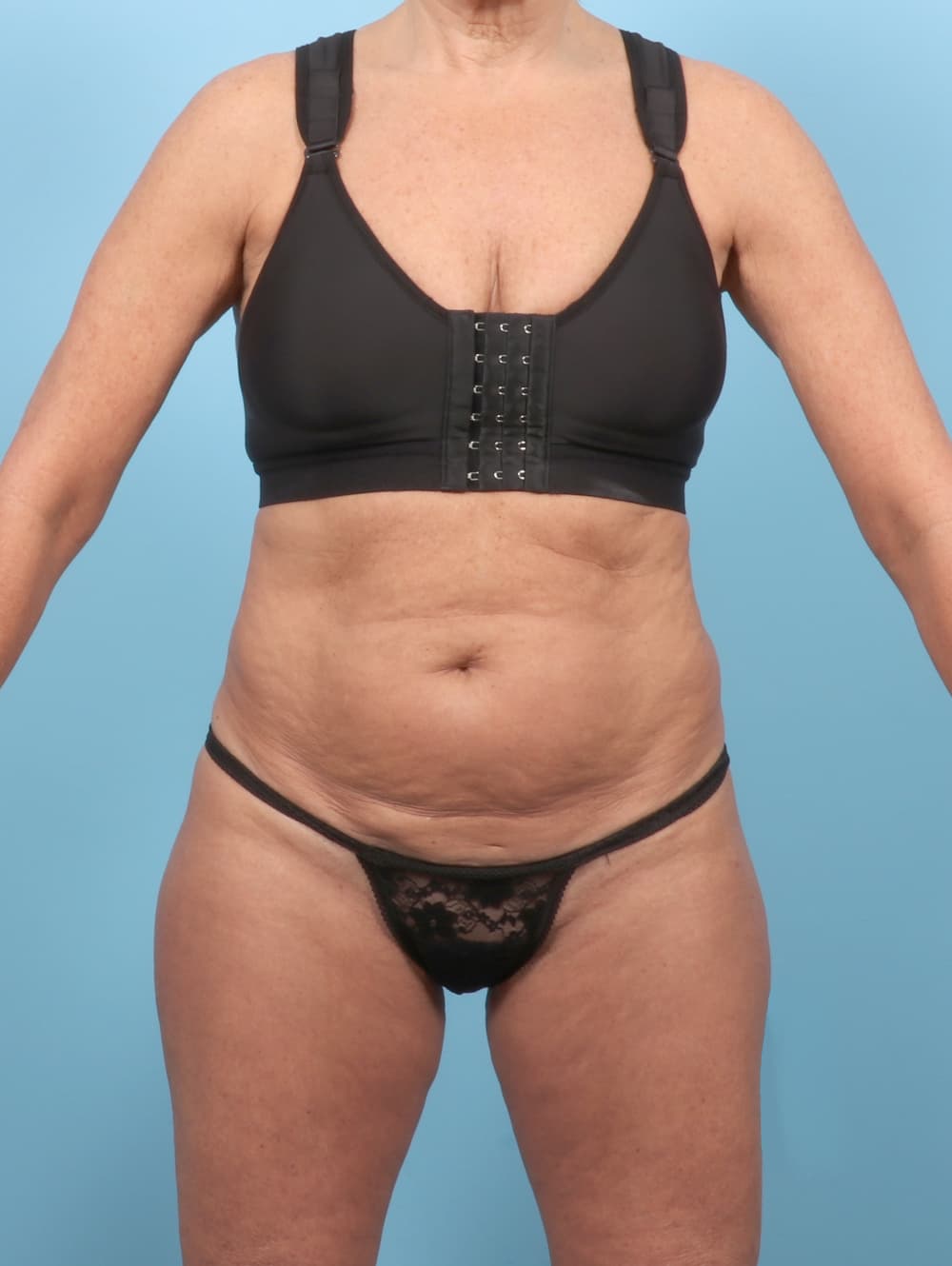 Tummy Tuck case #7355 before, image 1