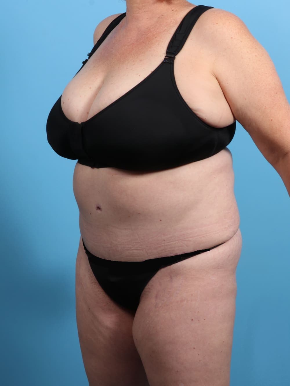 Tummy Tuck case #2825 after, image 2