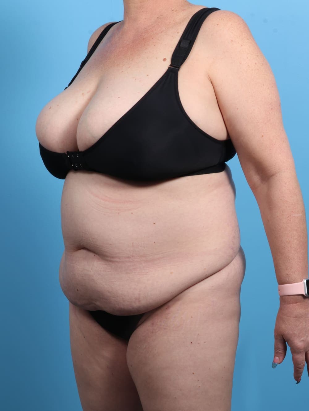 Tummy Tuck case #2825 before, image 2
