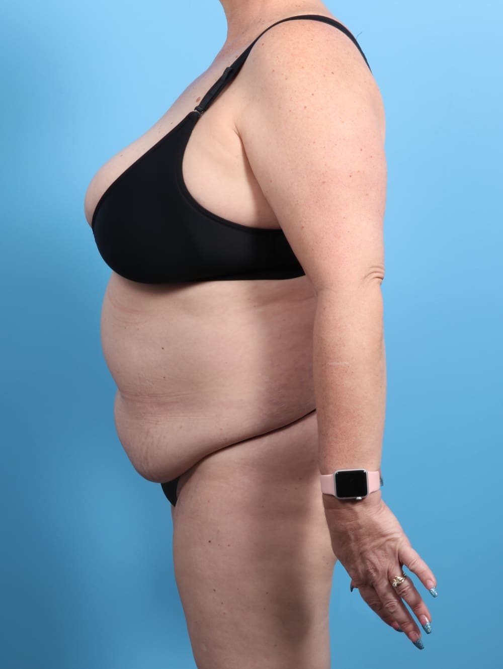 Tummy Tuck case #2825 before, image 3