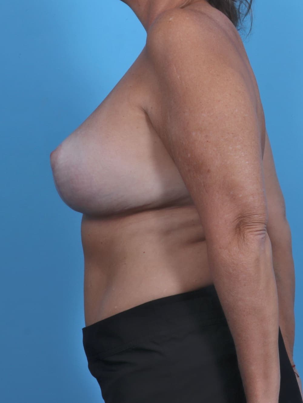 Breast Implant Revision case #4858 after, image 3
