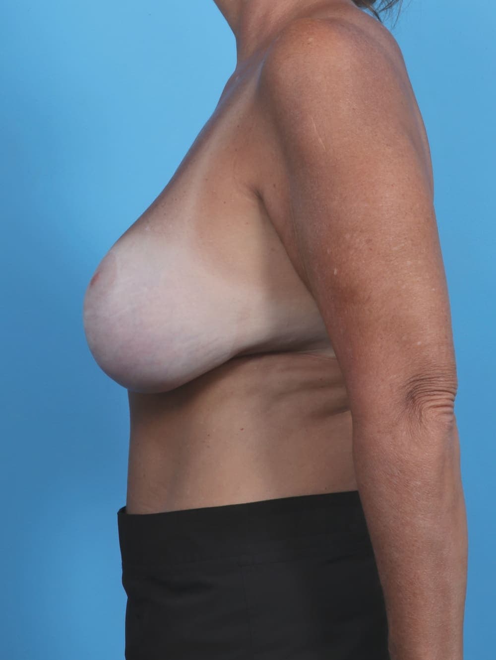 Breast Implant Revision case #4858 before, image 3