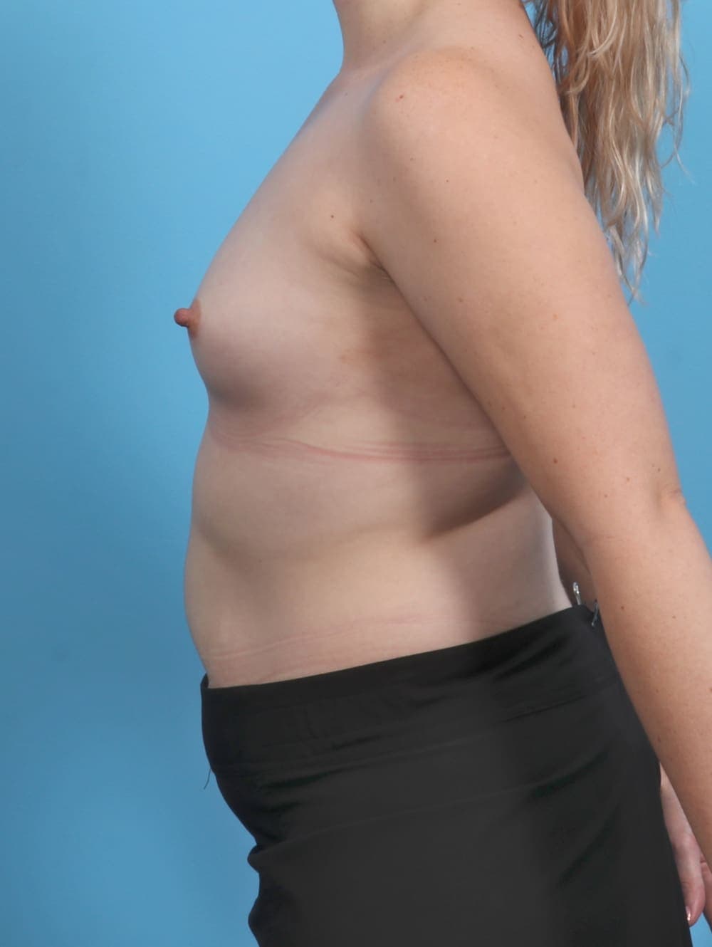 Breast Augmentation case #5506 before, image 3