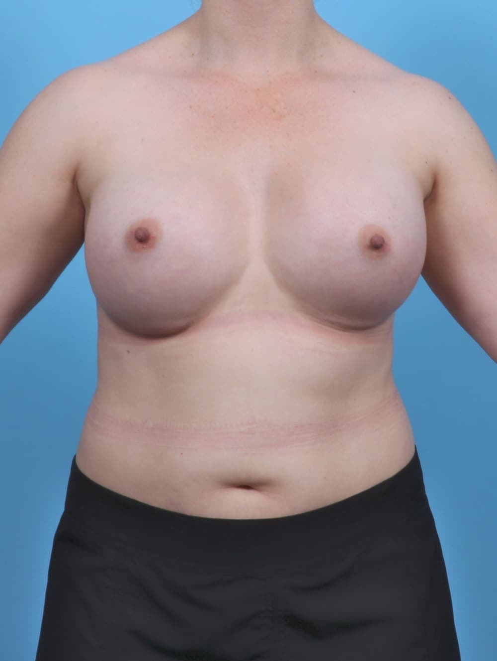 Breast Augmentation case #5506 after, image 1