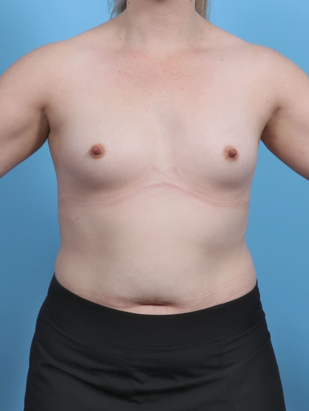 Breast Augmentation case #5506 before, image 1