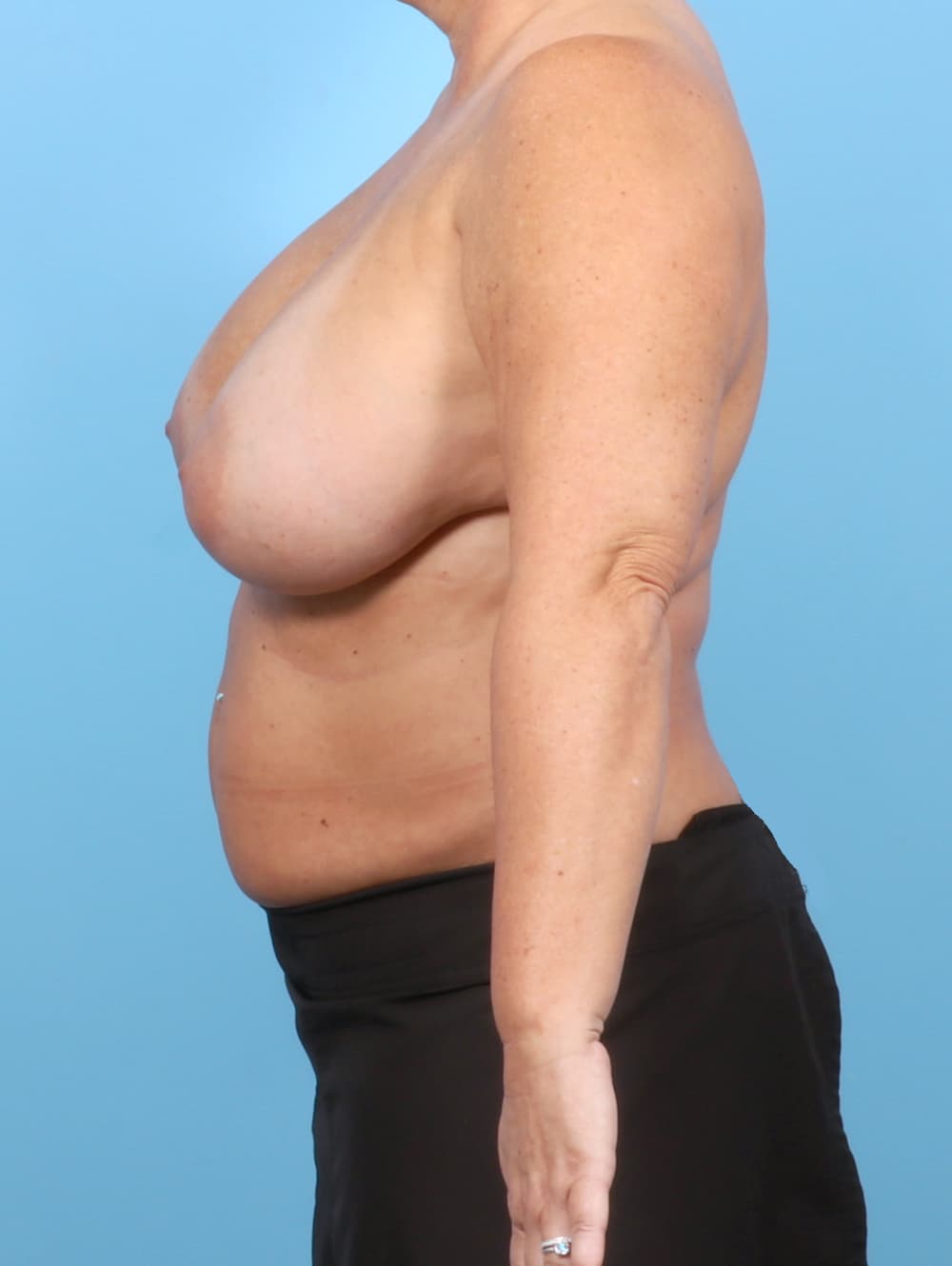 Breast Implant Removal with Lift case #7831 before, image 3