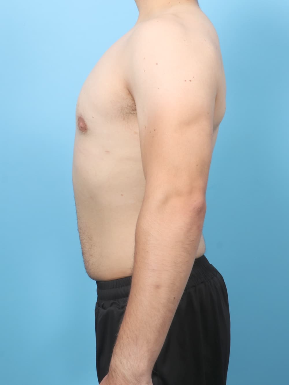Male Breast Reduction case #7998 after, image 3
