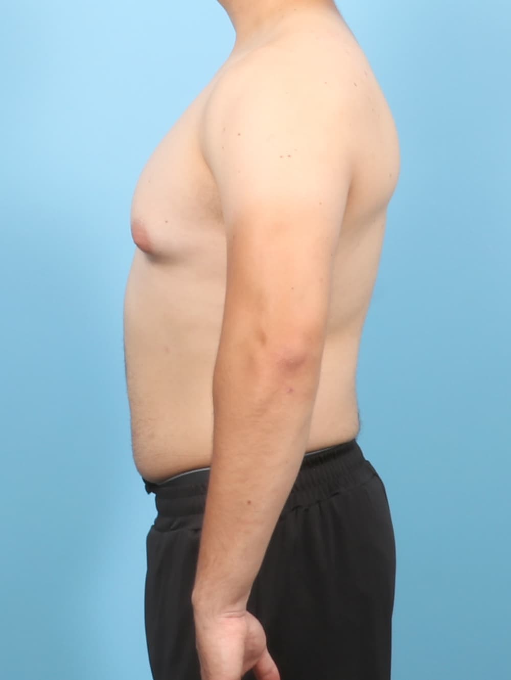 Male Breast Reduction case #7998 before, image 3