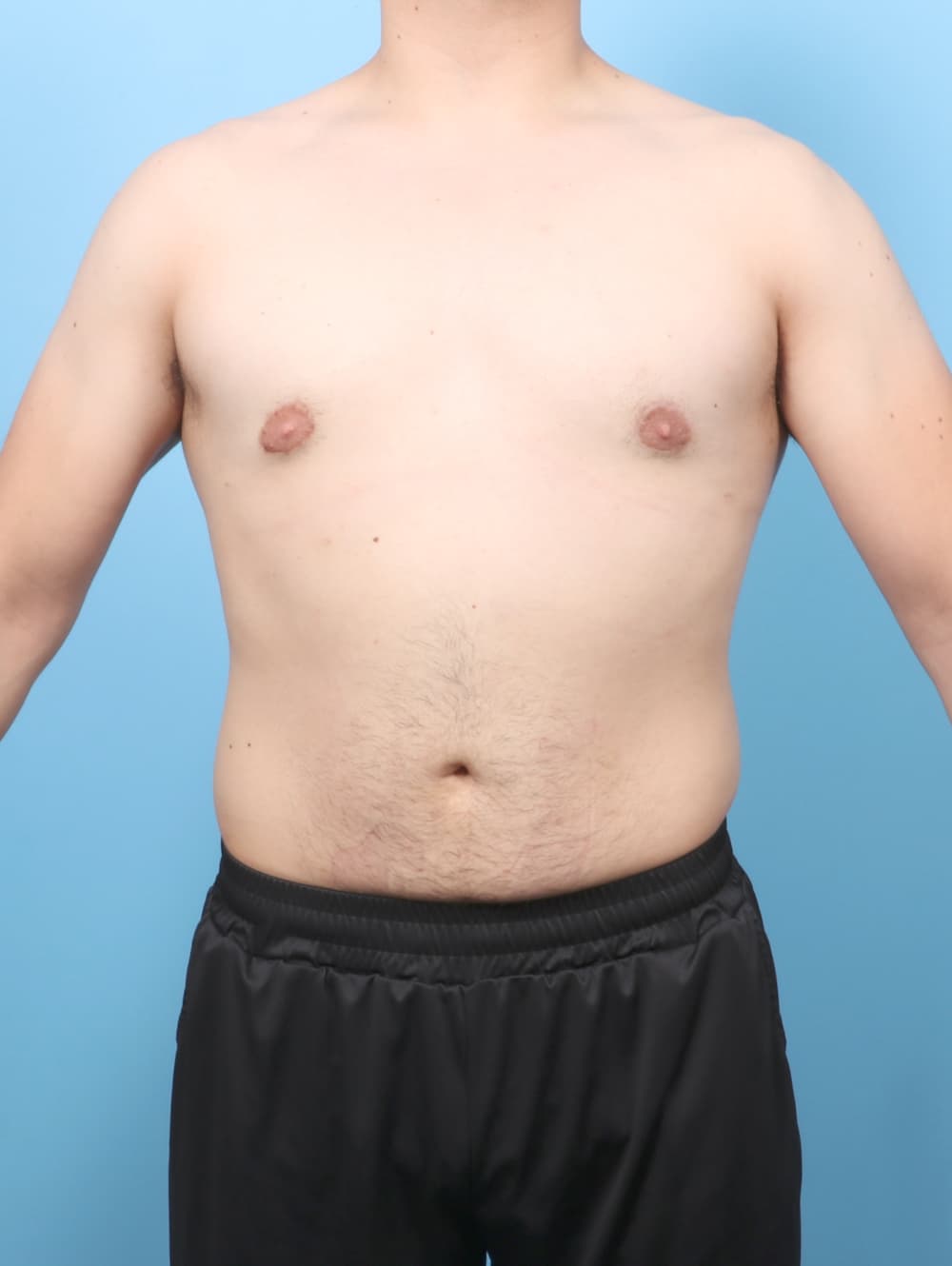 Male Breast Reduction case #7998 after, image 1