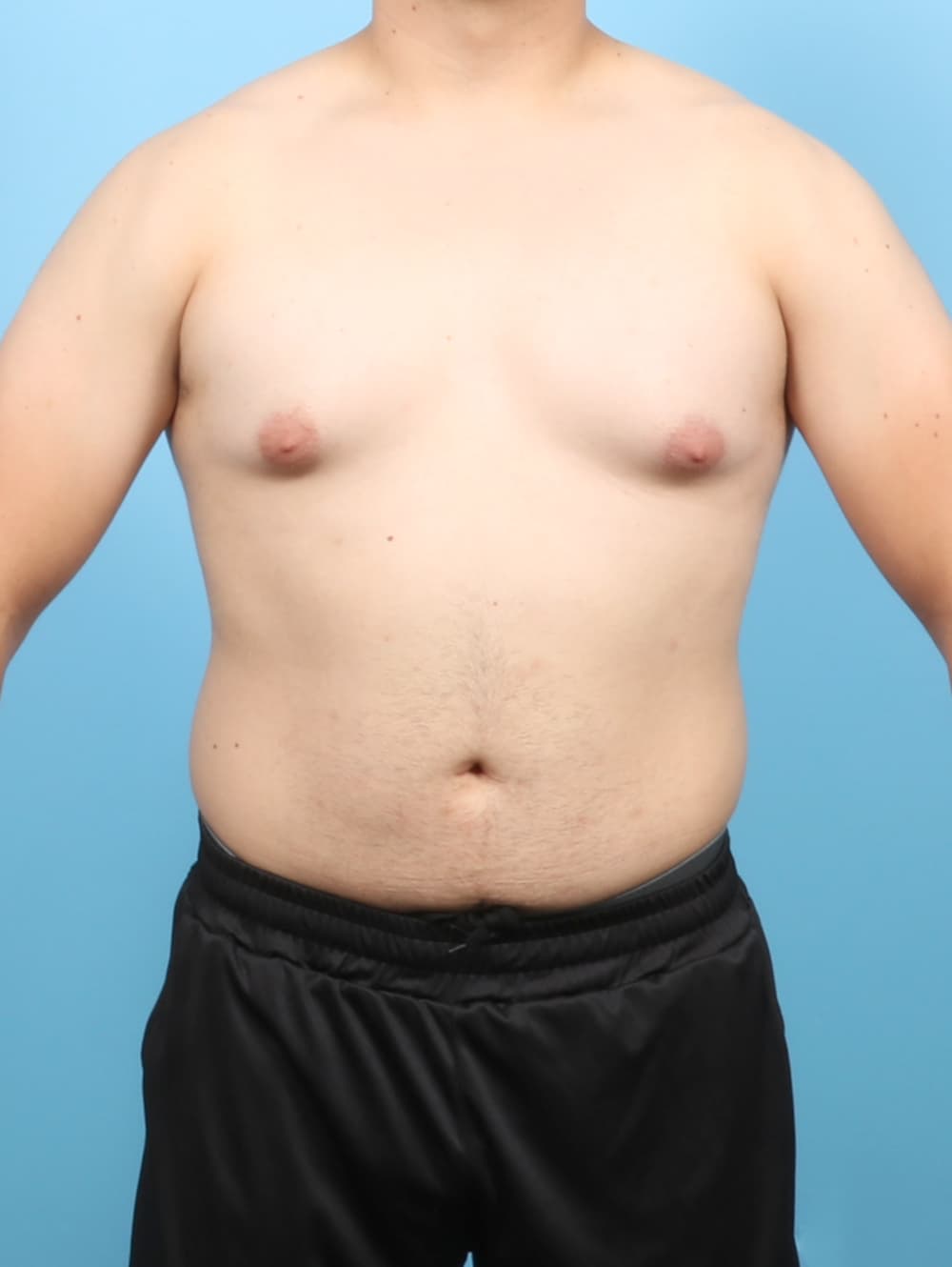 Male Breast Reduction case #7998 before, image 1