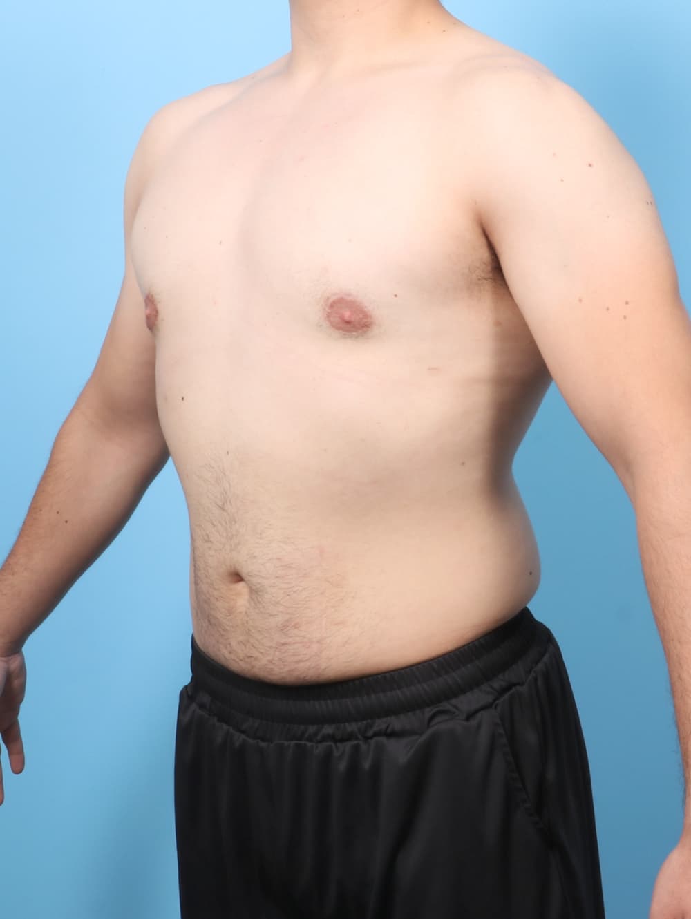 Male Breast Reduction case #7998 after, image 2