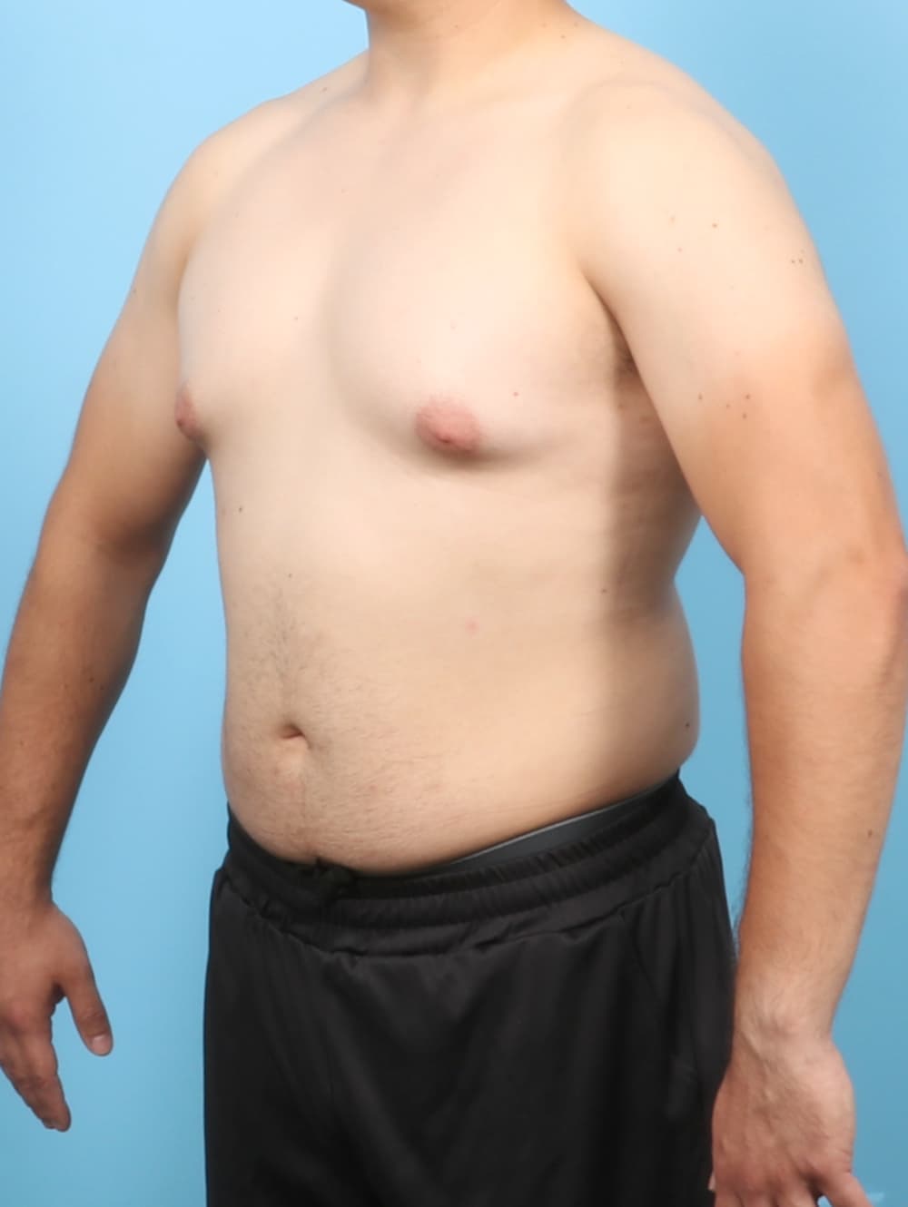 Male Breast Reduction case #7998 before, image 2