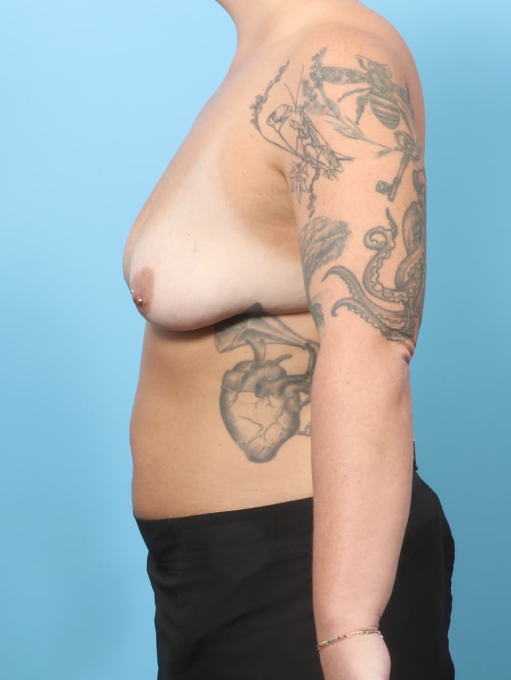 Breast Lift with Implants case #8920 before, image 3