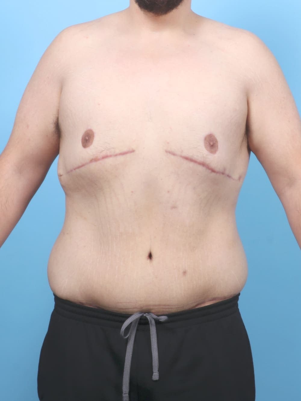Body Lift case #6417 after, image 1