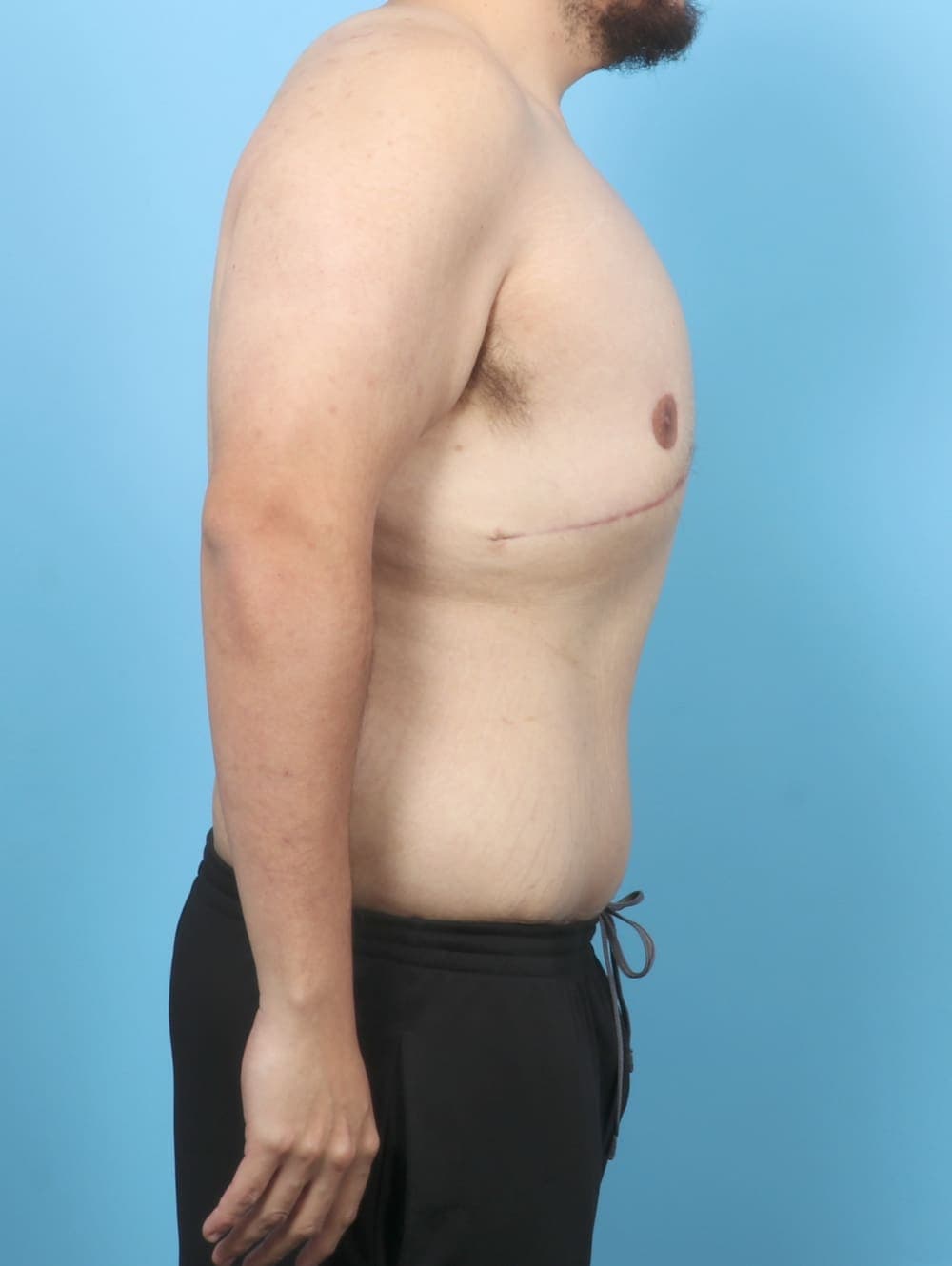 Body Lift case #6417 after, image 4