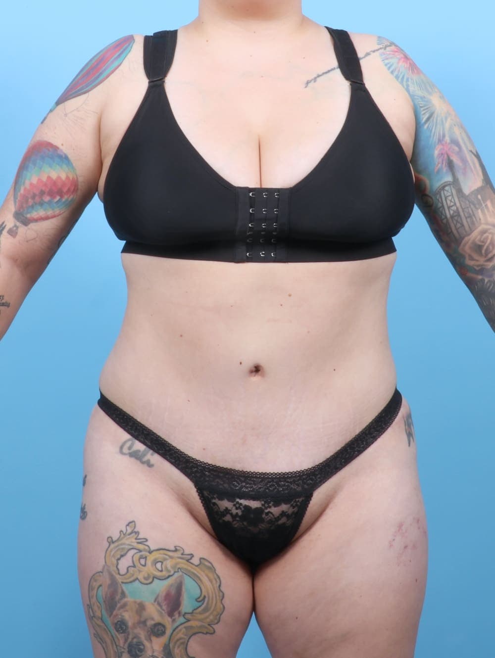 Tummy Tuck case #6325 after, image 1
