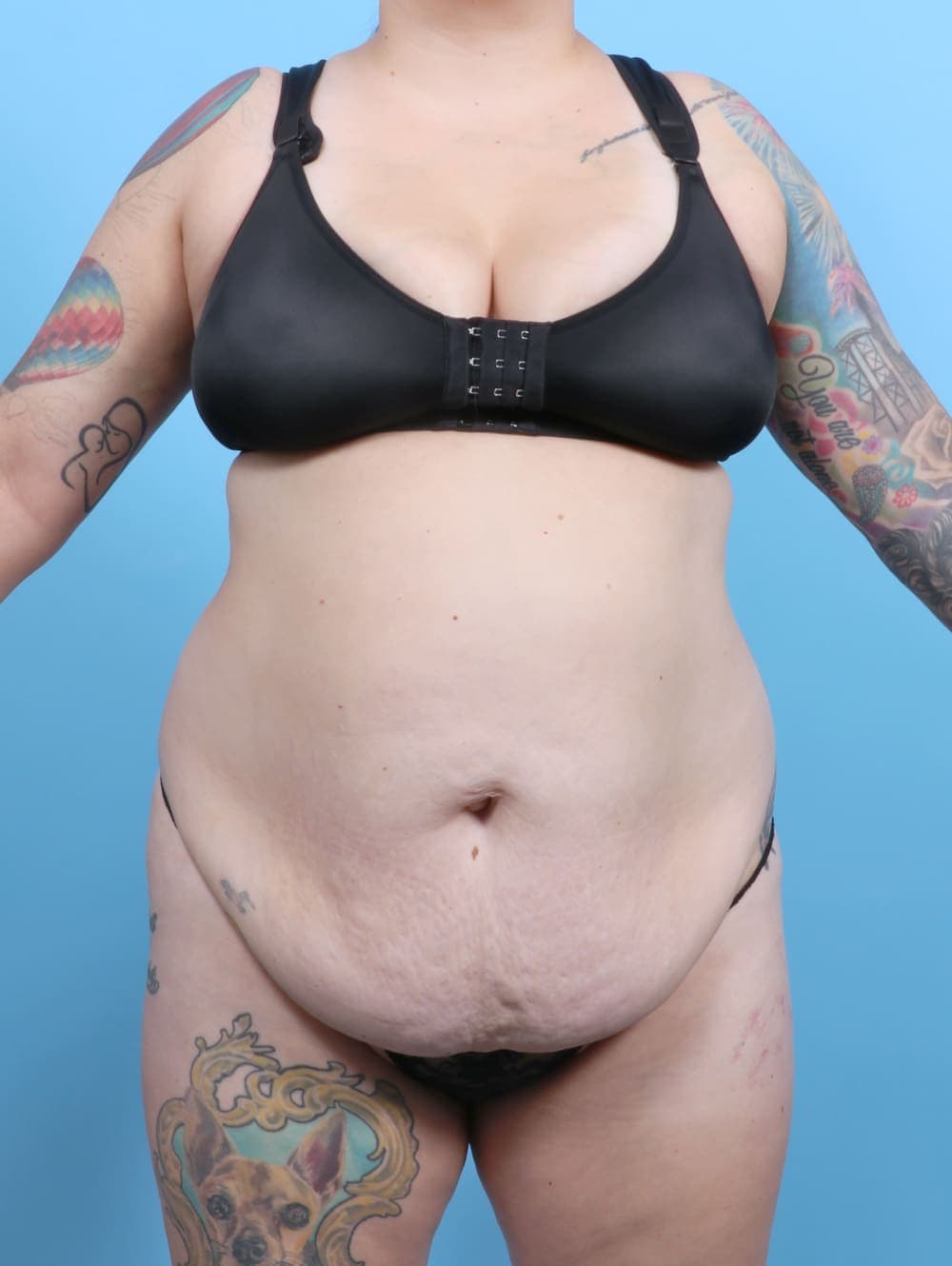 Tummy Tuck case #6325 before, image 1