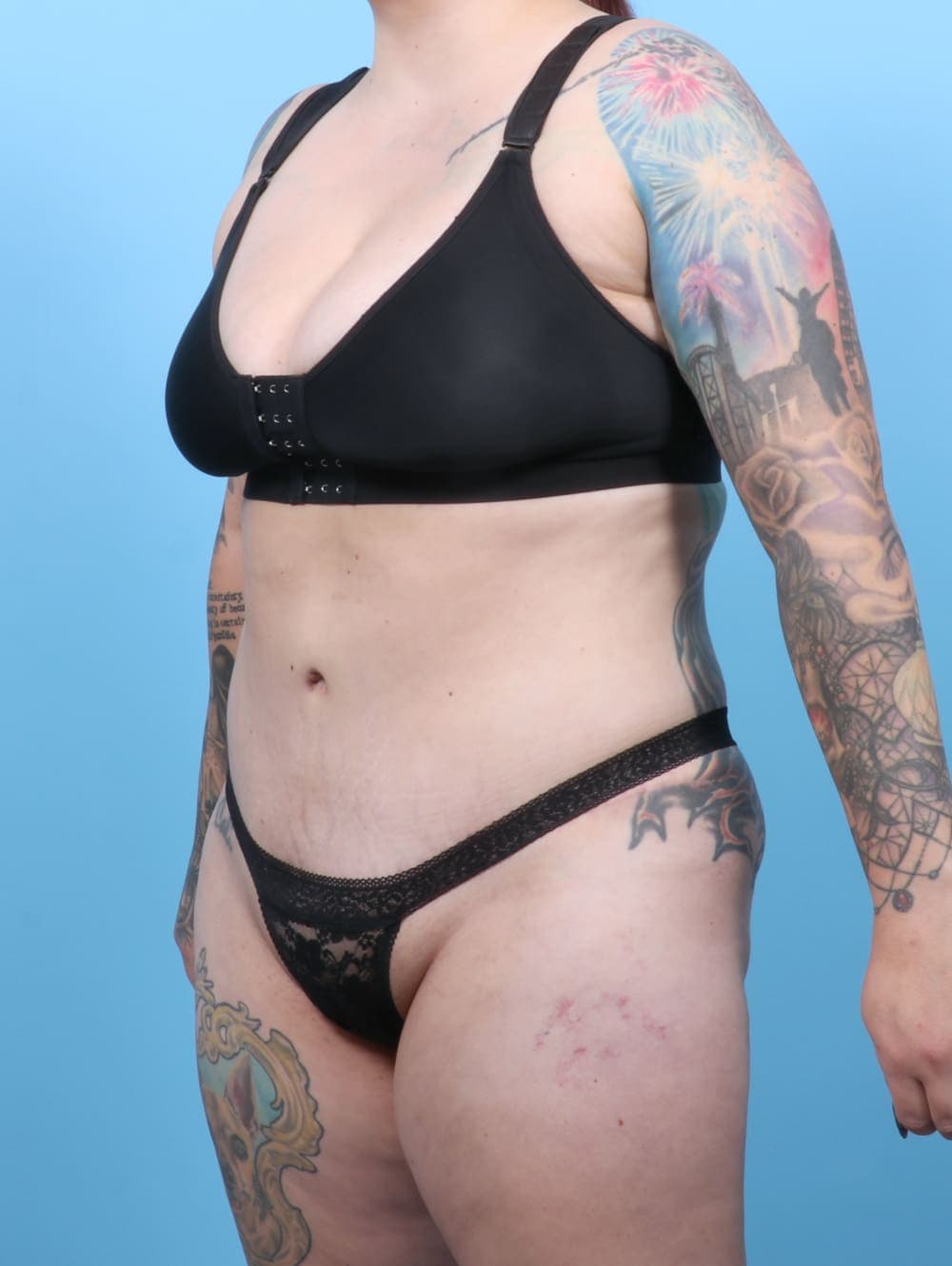 Tummy Tuck case #6325 after, image 3