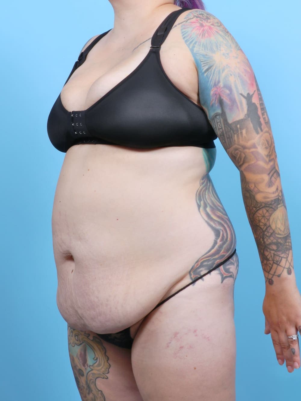 Tummy Tuck case #6325 before, image 3